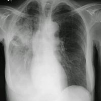 Pneumonie